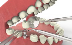 dental implants